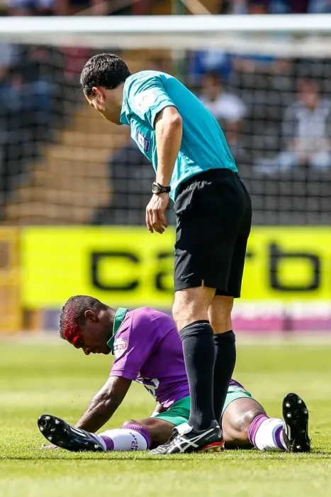 Framed Print : Bloodied Kieran Agard: The Intense Moment of Collision at Notts County vs. Bristol City Football Match, 2014 Framed Print : Bloodied Kieran Agard: The Intense Moment of Collision at Notts County vs. Bristol City Football Match, 2014